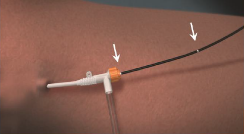 Процедура посегментной РЧА _ проведение процедуры _ 11 _ этап 2.png