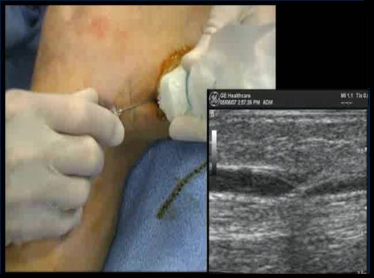 Процедура посегментной РЧА _ проведение процедуры _ 1.png