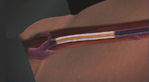 Процедура посегментной РЧА _ проведение процедуры _ 11 _ этап 1.png