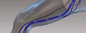 Проверка окклюзии вены.png