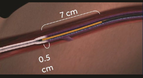 Процедура посегментной РЧА _ проведение процедуры _ 11 _ этап 3.png