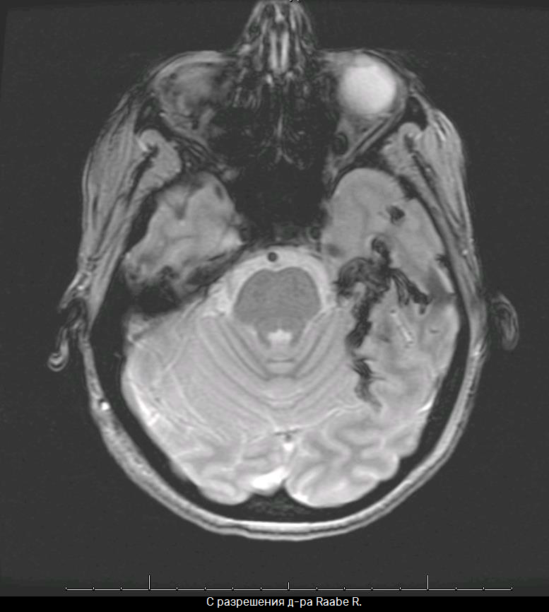 Мед.цианоакрилат и КД _ клей Raabe _ МРТ.png