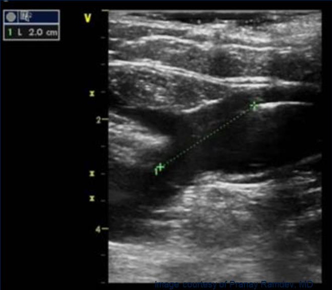 Процедура посегментной РЧА _ проведение процедуры _ 7.png
