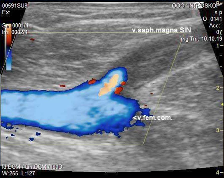 Процедура посегментной РЧА _ проведение процедуры _ регламент после.png