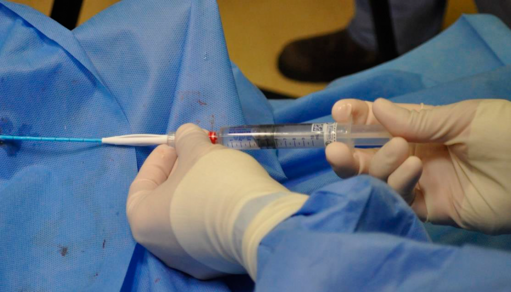 VenaSeal Procedure.png