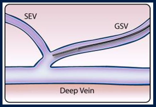 Процедура посегментной РЧА _ проведение процедуры _ 4.png