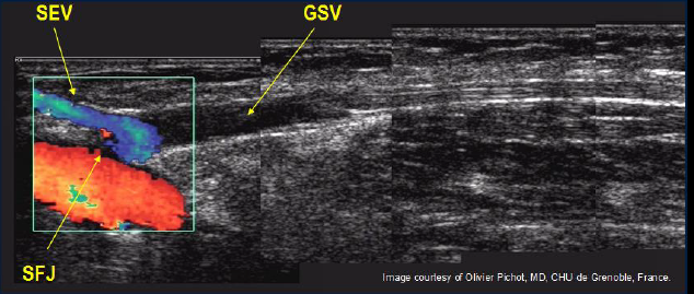 Процедура посегментной РЧА _ проведение процедуры _ 10.png