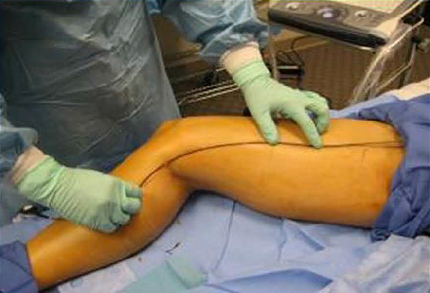 Процедура посегментной РЧА _ подготовка к процедуре _ 4.png