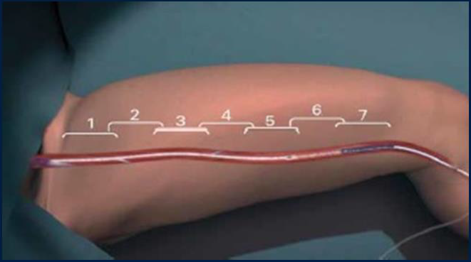 Процедура посегментной РЧА _ посегментная абл _ 2.png