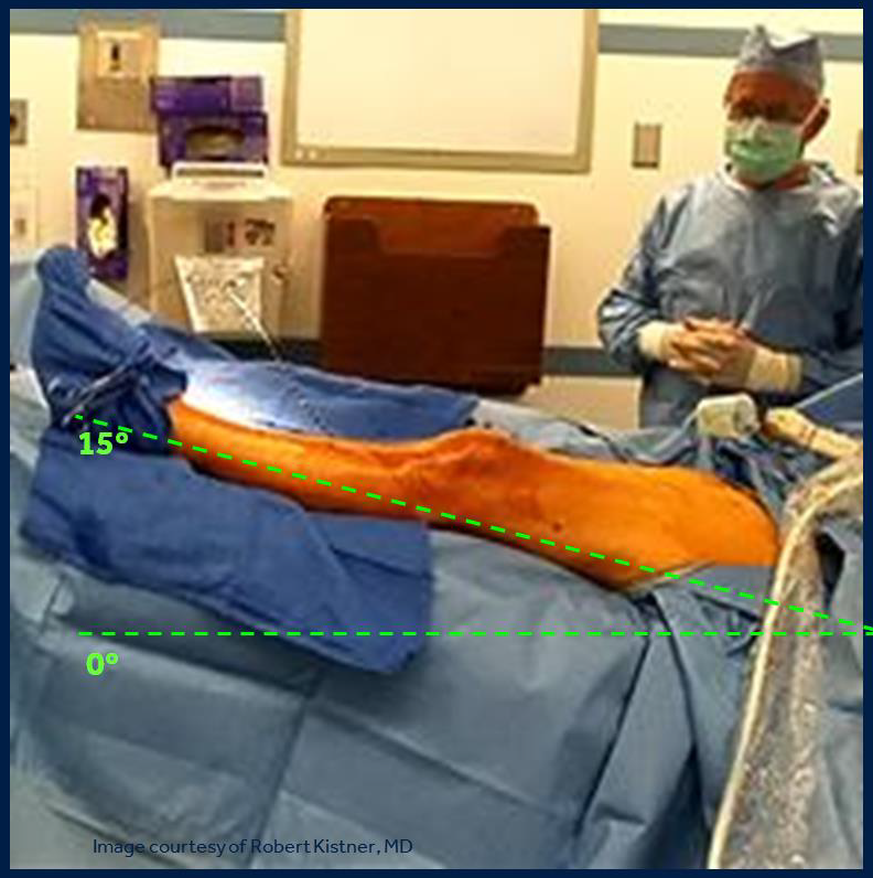 Процедура посегментной РЧА _ положение Тренделенбурга.png