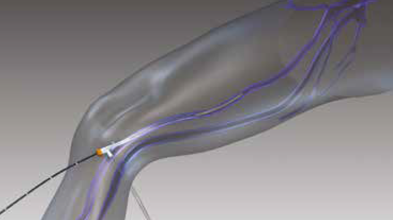 доступ в вену